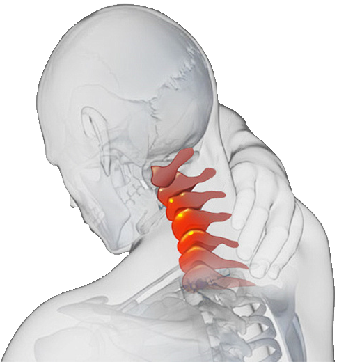 CERVICAL-PEEK-CAGE